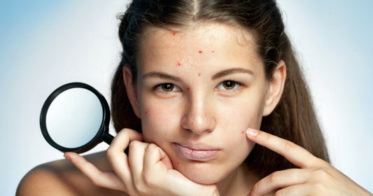 Menstruation & Skin: The Monthly Hormonal Betrayal